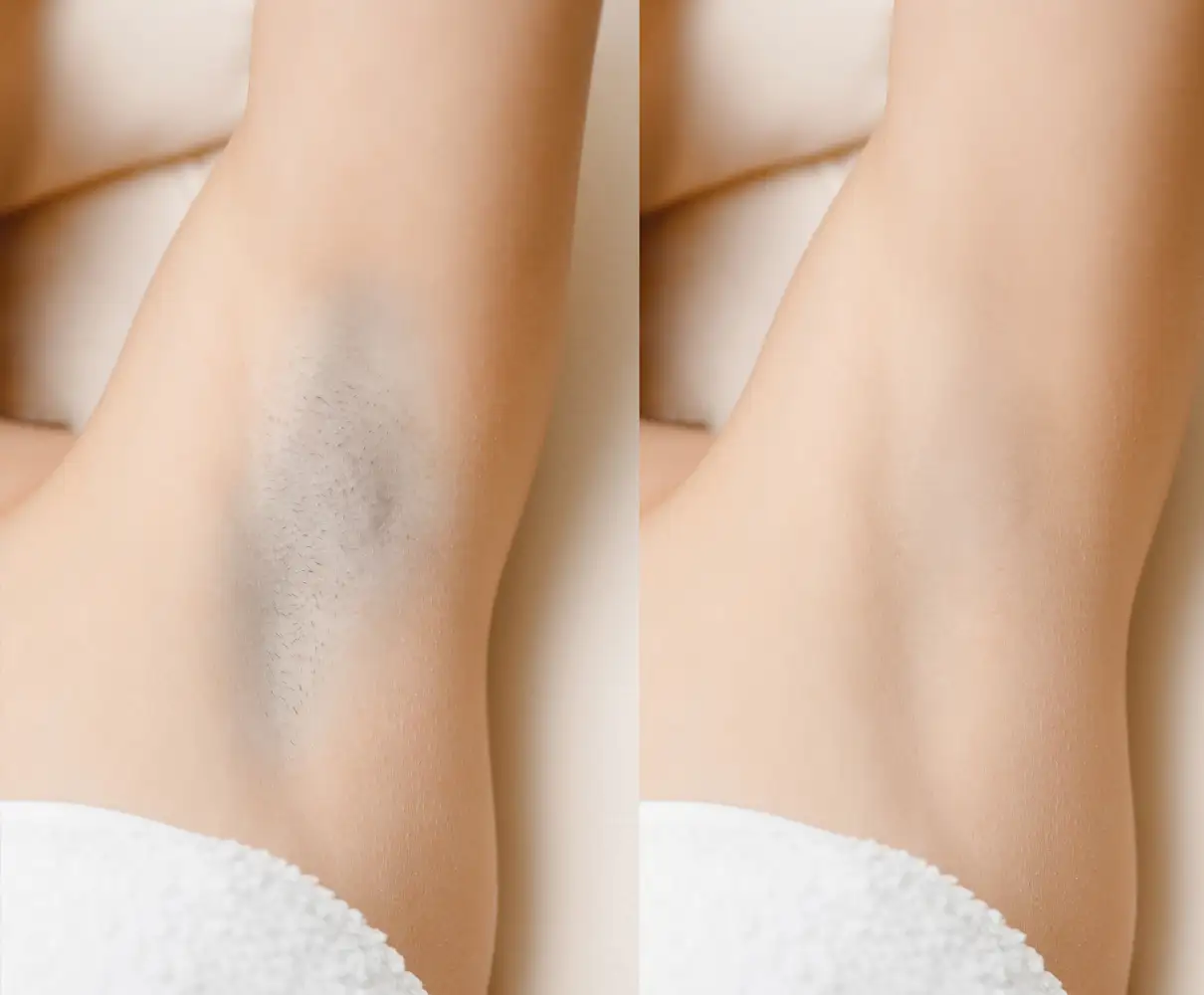 Laser Hair Removal before after